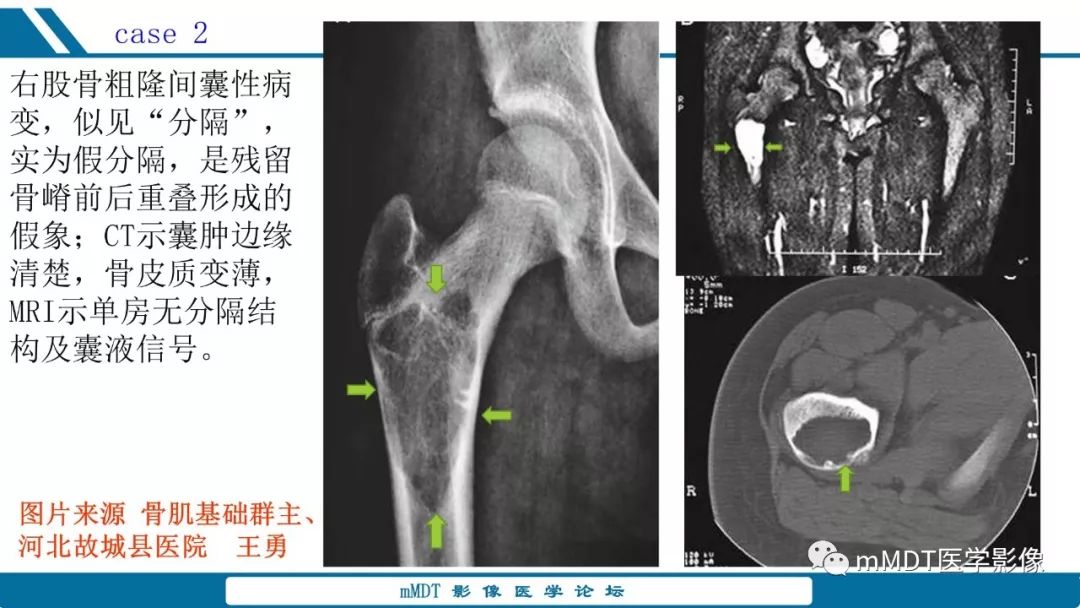 【PPT】未定性骨肿瘤影像学表现