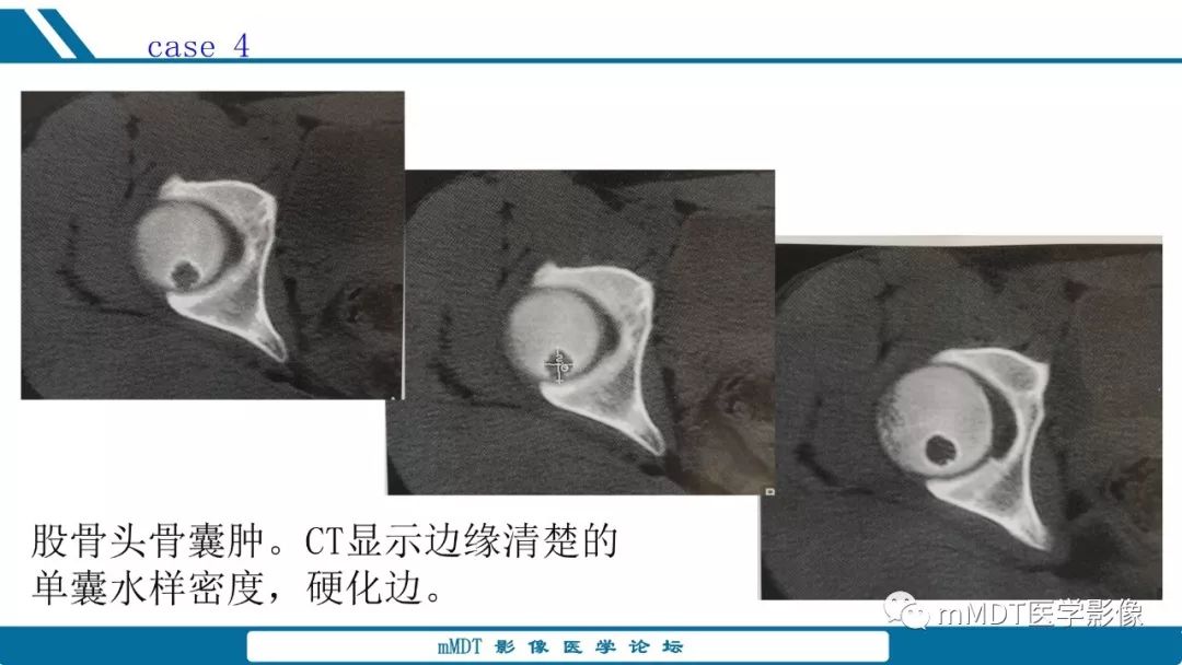 【PPT】未定性骨肿瘤影像学表现