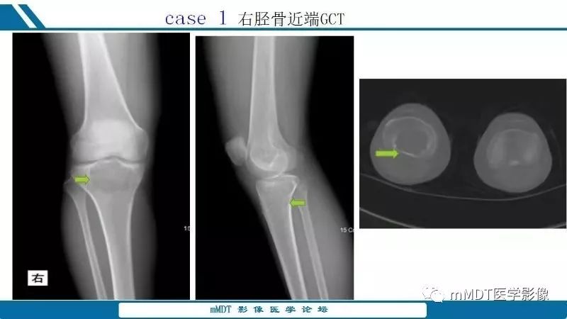 【PPT】未定性骨肿瘤影像学表现