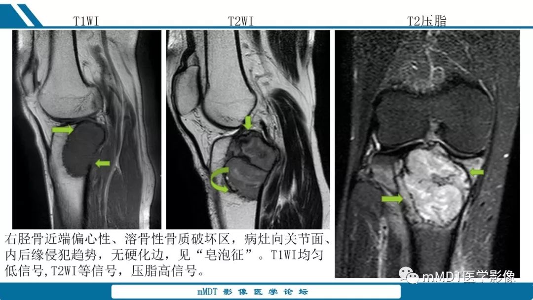 【PPT】未定性骨肿瘤影像学表现