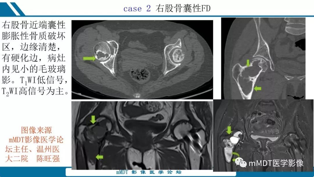 【PPT】未定性骨肿瘤影像学表现