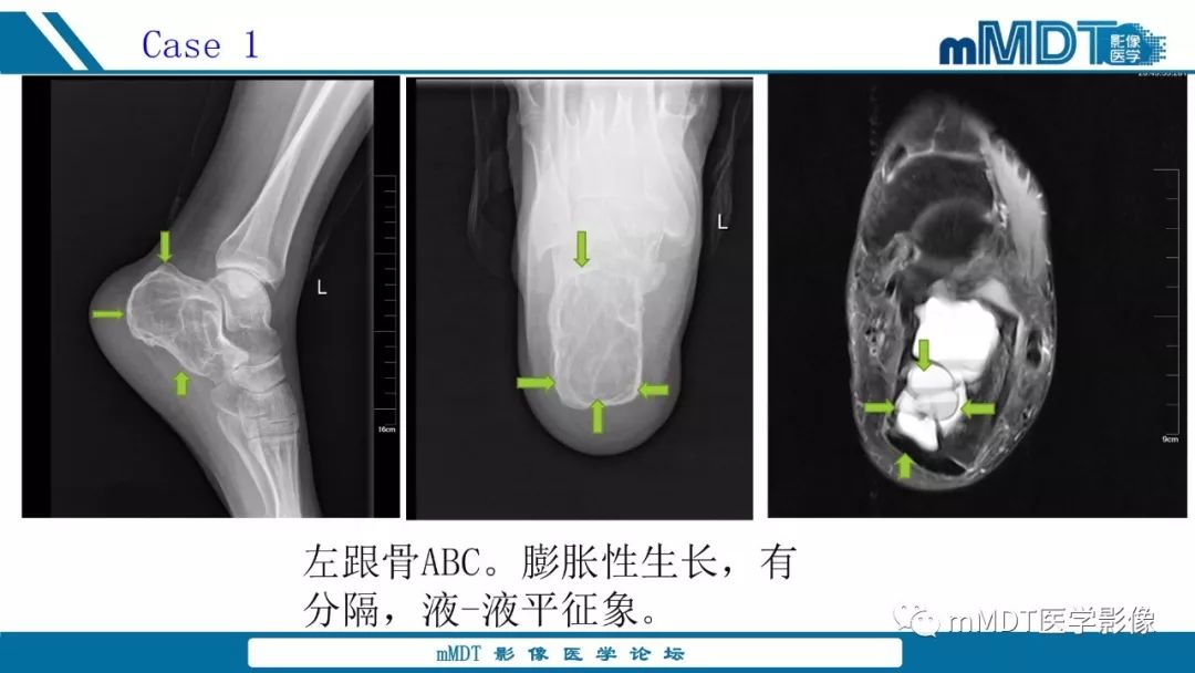 【PPT】未定性骨肿瘤影像学表现