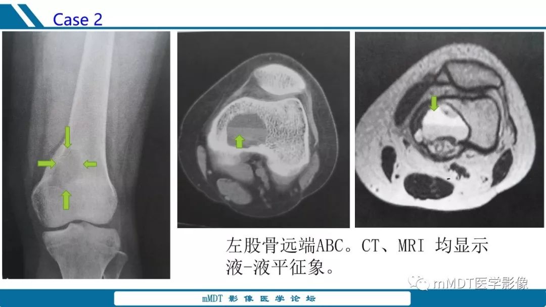 【PPT】未定性骨肿瘤影像学表现