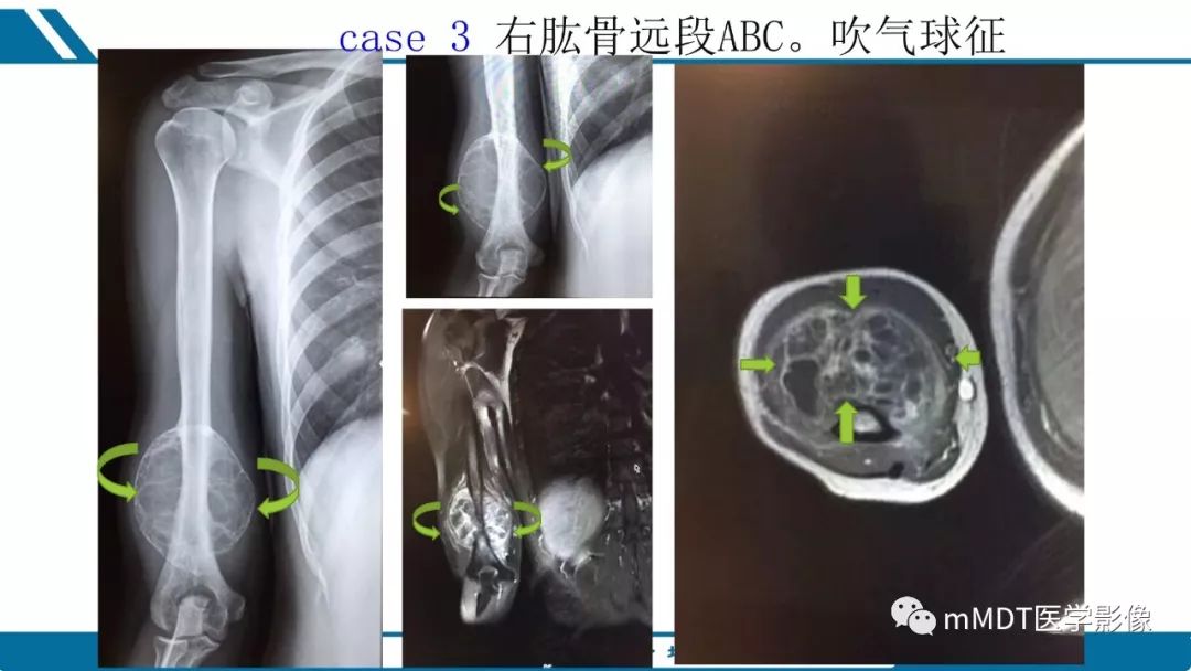 【PPT】未定性骨肿瘤影像学表现