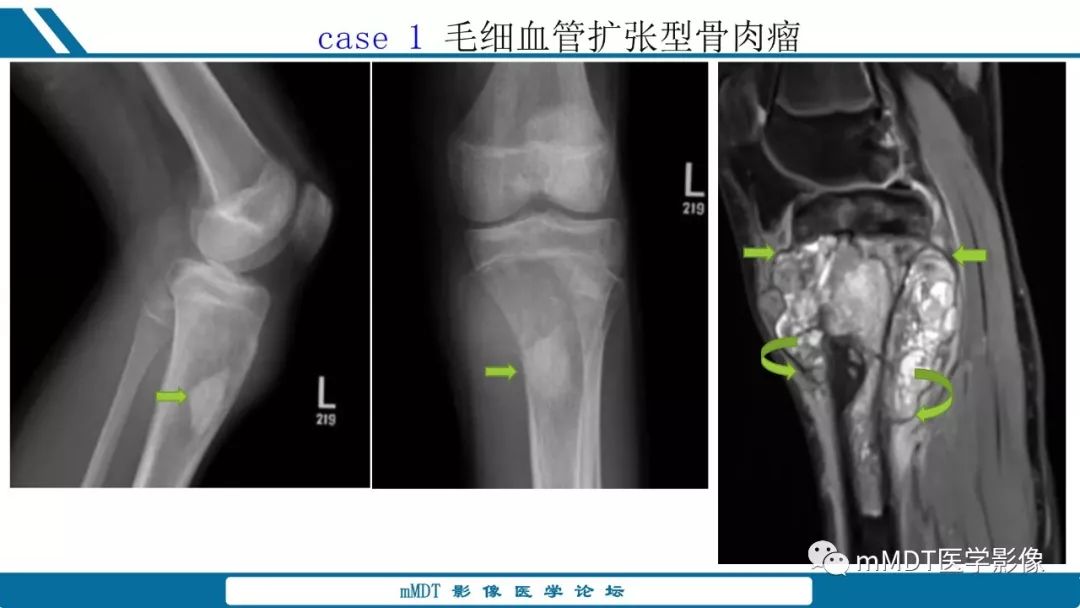 【PPT】未定性骨肿瘤影像学表现