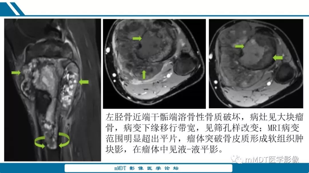 【PPT】未定性骨肿瘤影像学表现