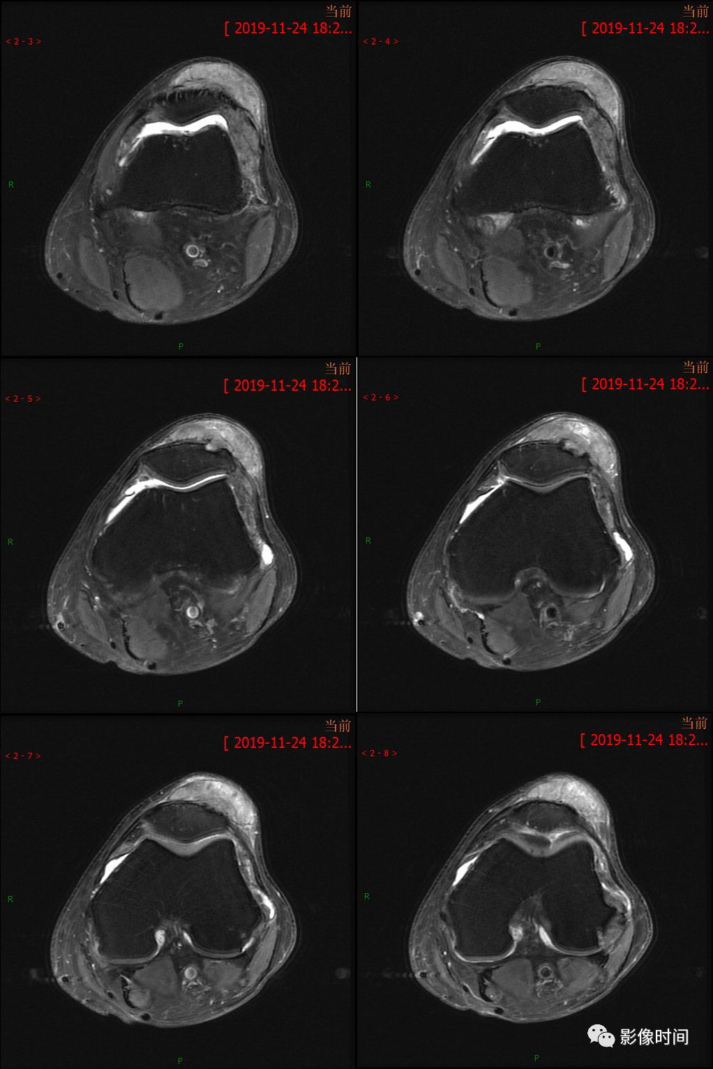【病例】痛风性关节炎1例MR影像 【病例】痛风性关节炎1例MR影像