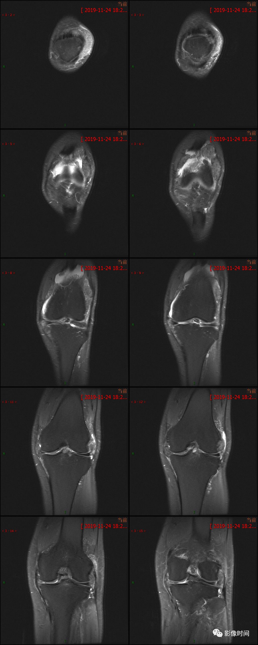 【病例】痛风性关节炎1例MR影像 【病例】痛风性关节炎1例MR影像