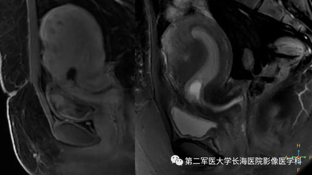 【PPT】剖宫产术后子宫瘢痕妊娠的MR诊断