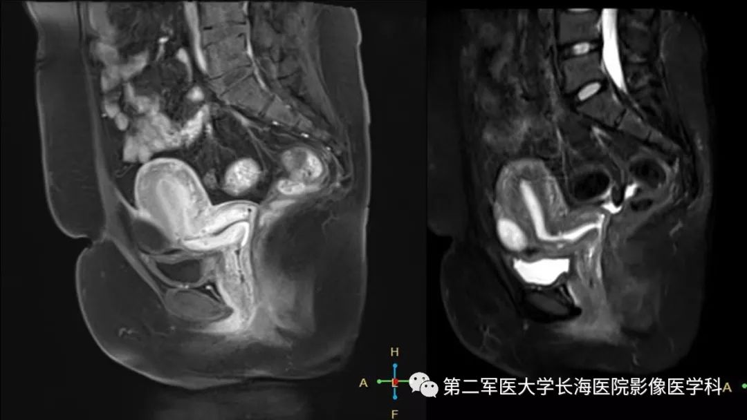 【PPT】剖宫产术后子宫瘢痕妊娠的MR诊断