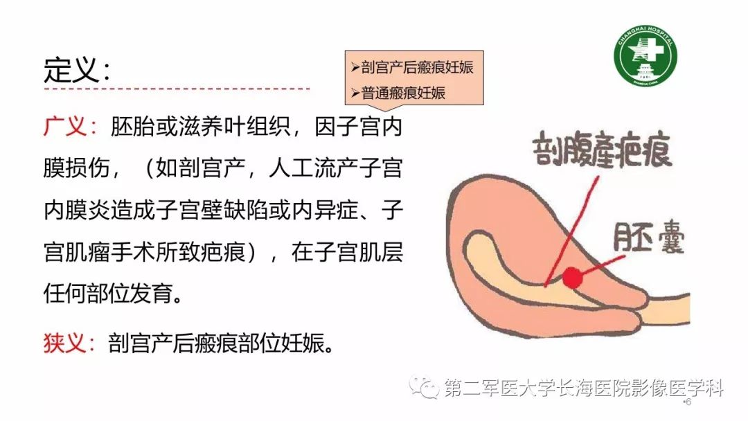 【PPT】剖宫产术后子宫瘢痕妊娠的MR诊断
