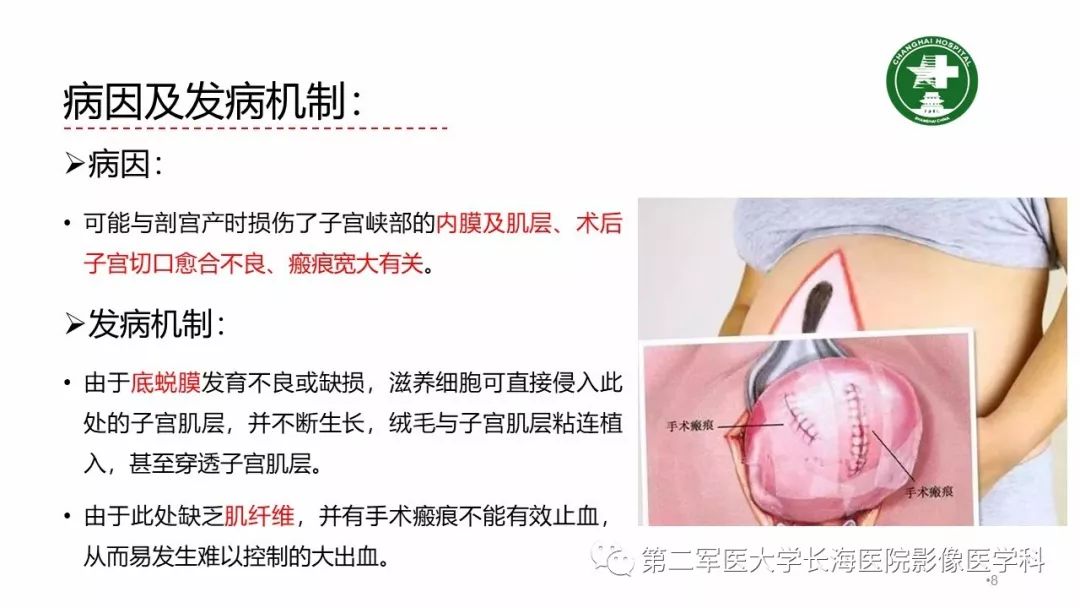 【PPT】剖宫产术后子宫瘢痕妊娠的MR诊断