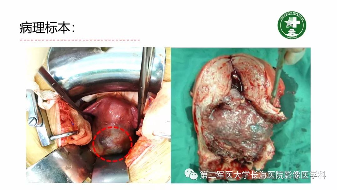【PPT】剖宫产术后子宫瘢痕妊娠的MR诊断