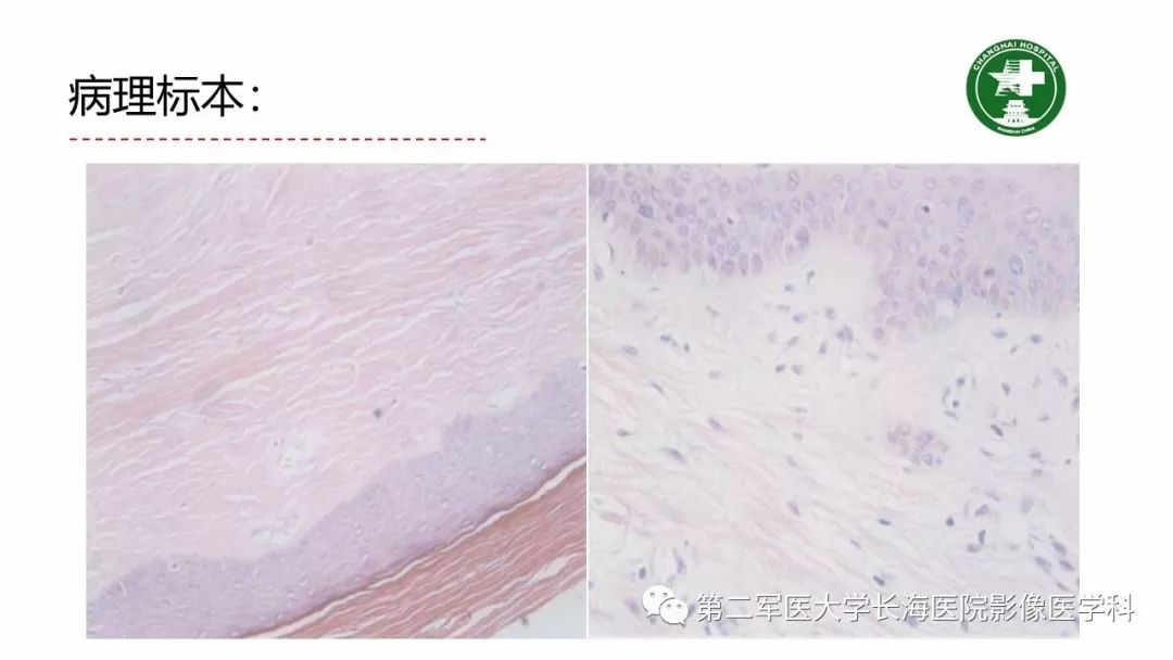 【PPT】剖宫产术后子宫瘢痕妊娠的MR诊断