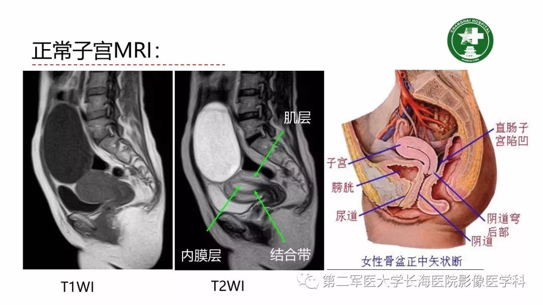 【PPT】剖宫产术后子宫瘢痕妊娠的MR诊断