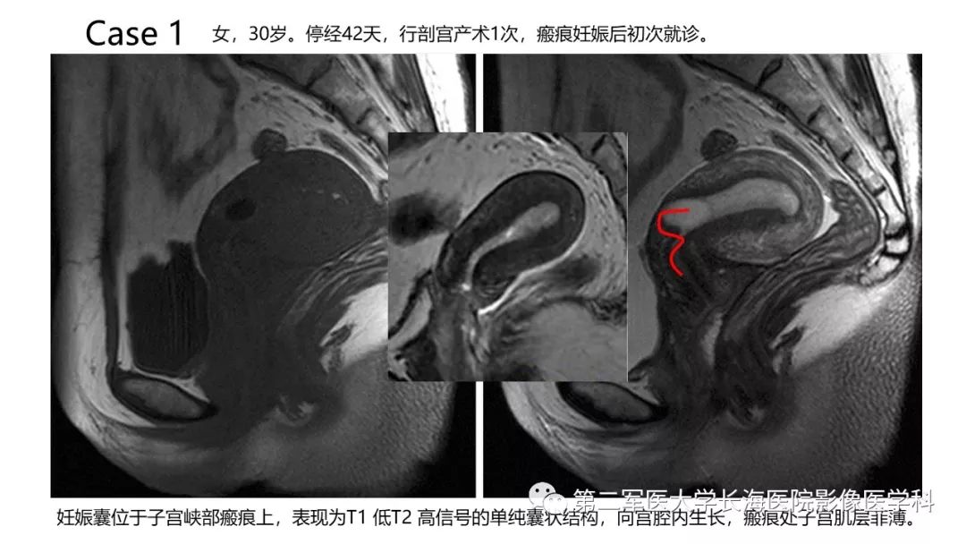 【PPT】剖宫产术后子宫瘢痕妊娠的MR诊断