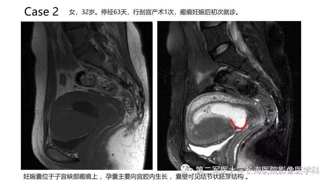 【PPT】剖宫产术后子宫瘢痕妊娠的MR诊断