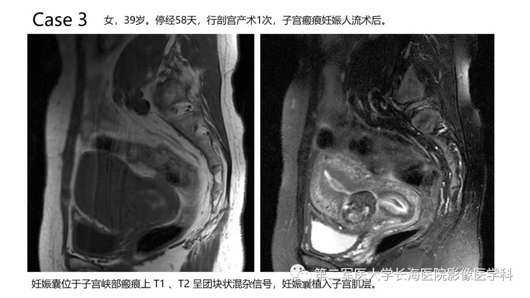 【PPT】剖宫产术后子宫瘢痕妊娠的MR诊断