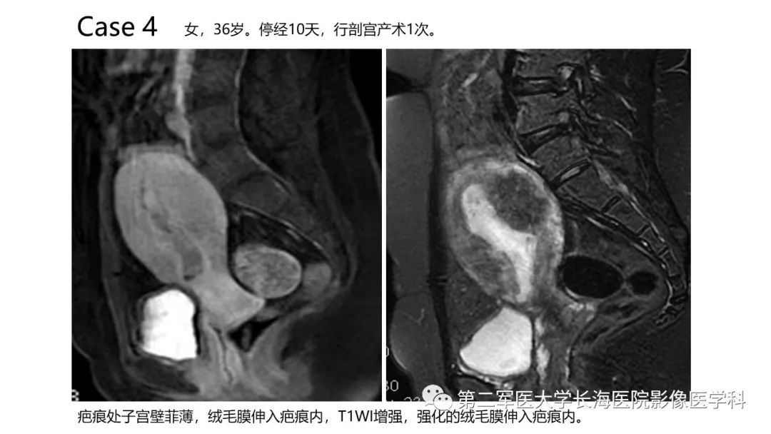 【PPT】剖宫产术后子宫瘢痕妊娠的MR诊断