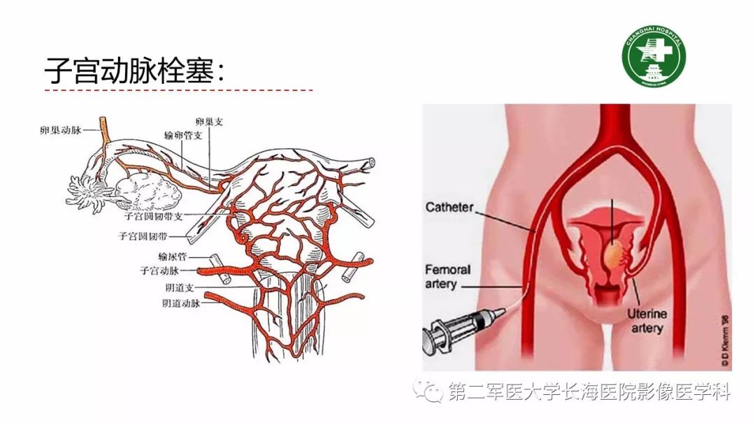 【PPT】剖宫产术后子宫瘢痕妊娠的MR诊断