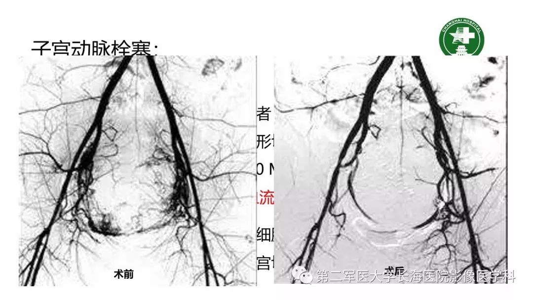 【PPT】剖宫产术后子宫瘢痕妊娠的MR诊断