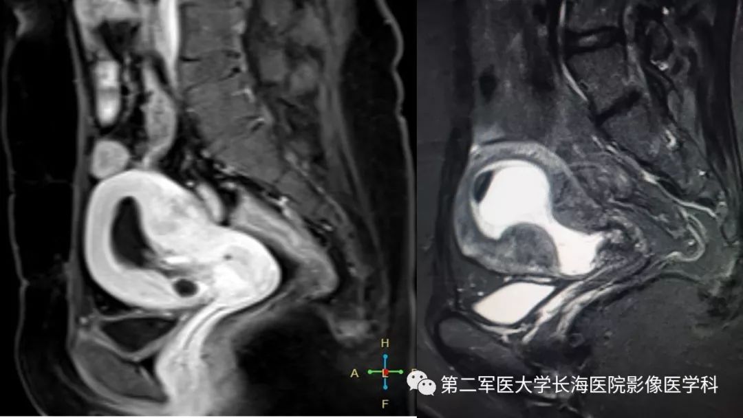 【PPT】剖宫产术后子宫瘢痕妊娠的MR诊断