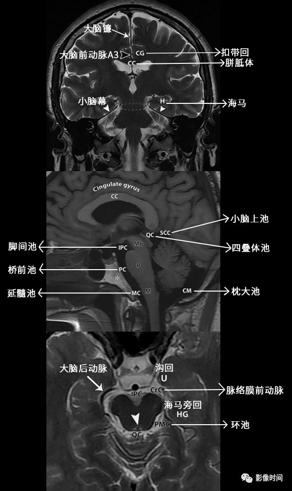 脑疝的分类及影像学特点图解 脑疝的分类及影像学特点图解