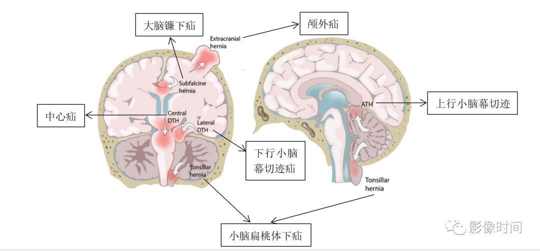 脑疝的分类及影像学特点图解 脑疝的分类及影像学特点图解