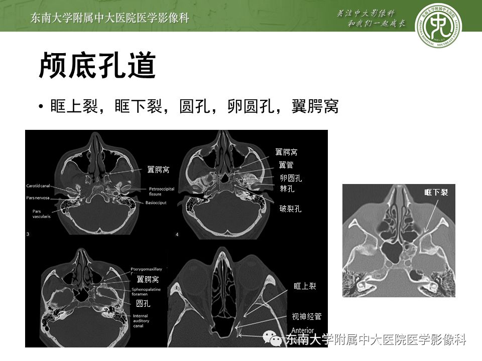 【PPT】三叉神经影像解剖及常见疾病