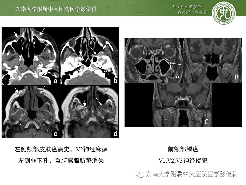 【PPT】三叉神经影像解剖及常见疾病