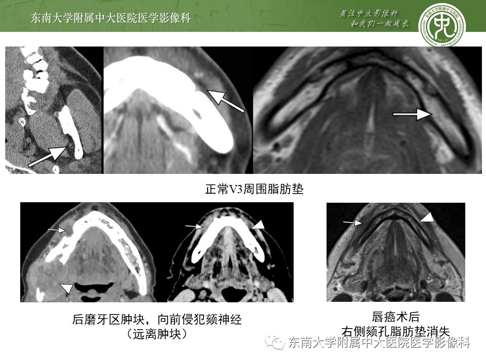 【PPT】三叉神经影像解剖及常见疾病