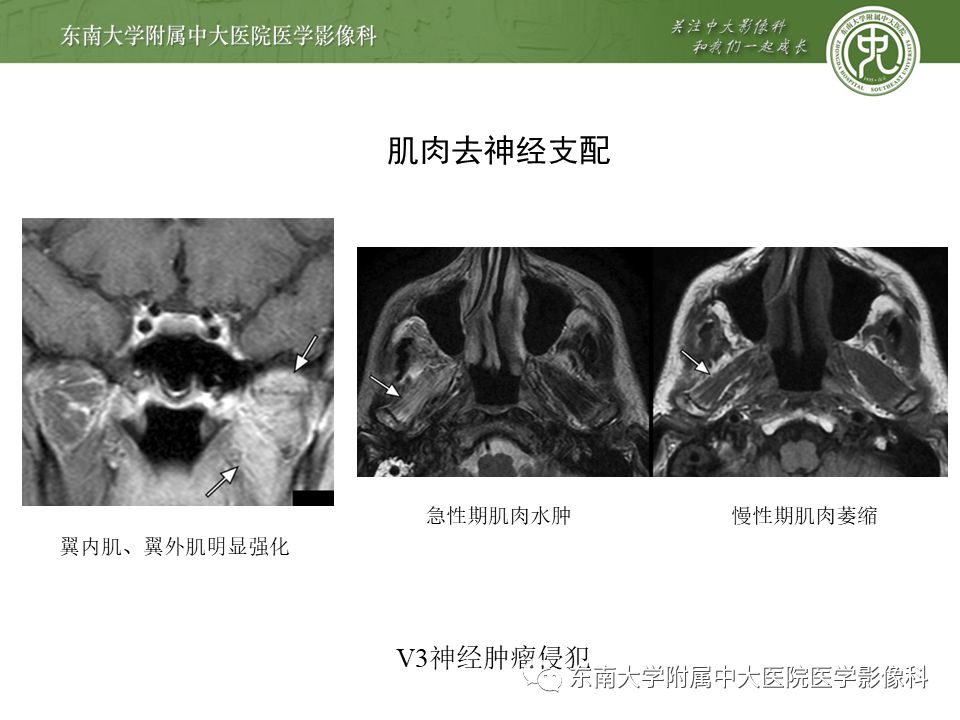 【PPT】三叉神经影像解剖及常见疾病