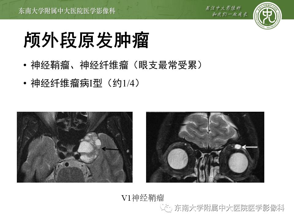 【PPT】三叉神经影像解剖及常见疾病