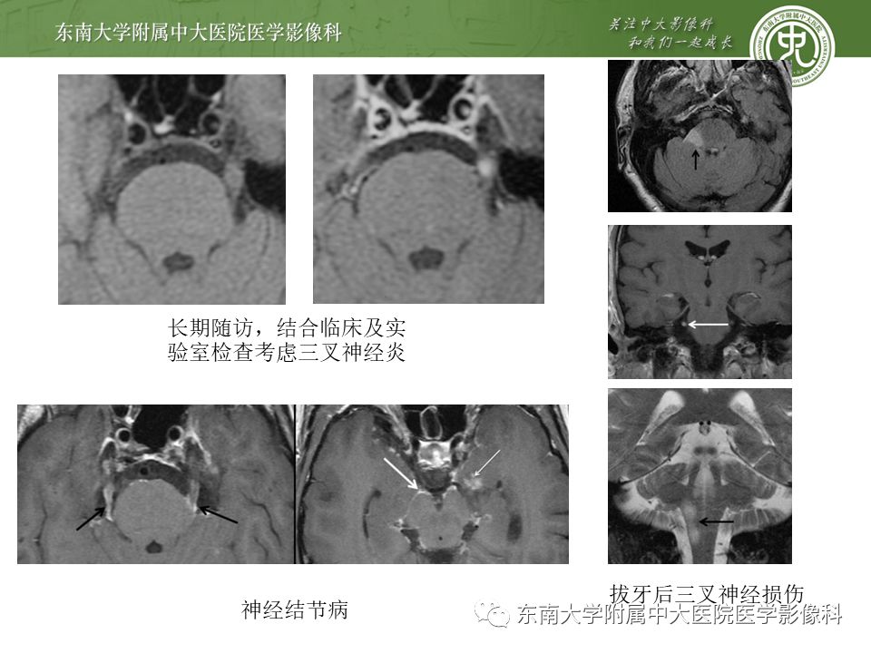 【PPT】三叉神经影像解剖及常见疾病