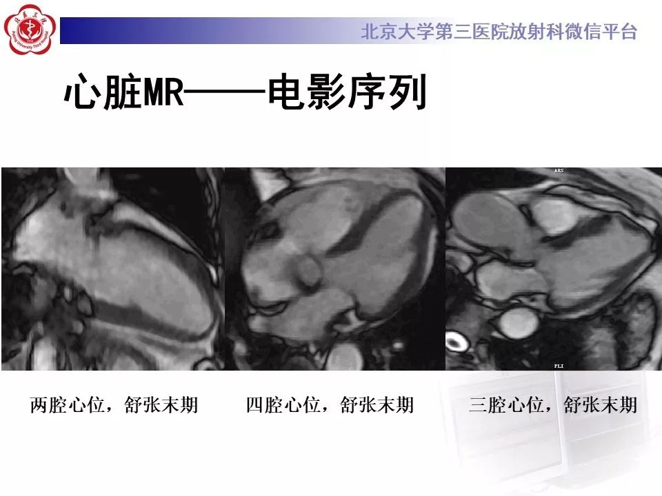 【PPT】心脏憩室