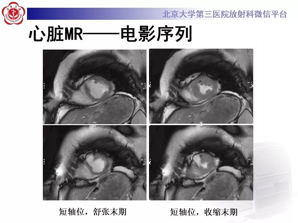 【PPT】心脏憩室