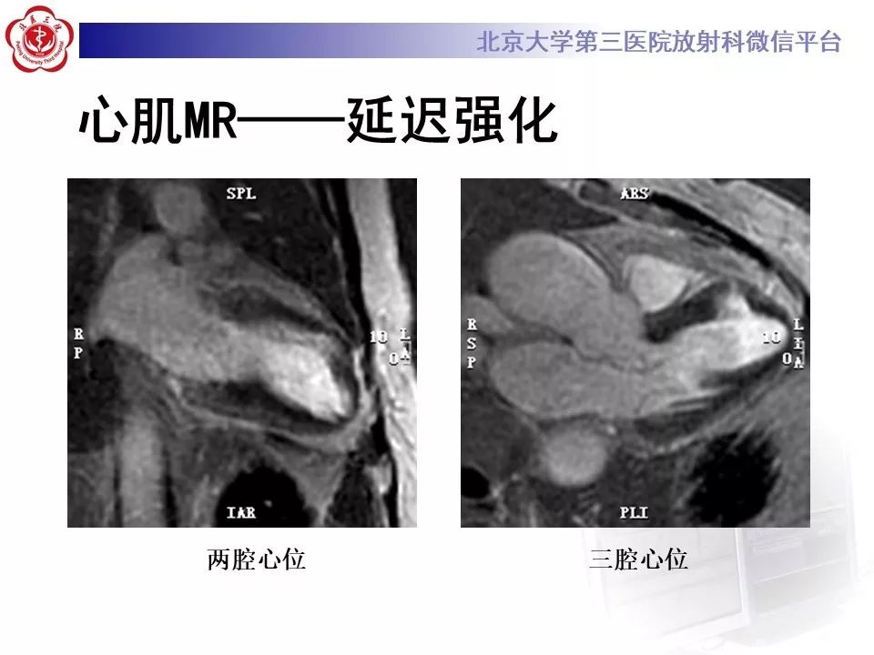 【PPT】心脏憩室