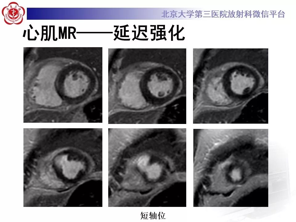 【PPT】心脏憩室