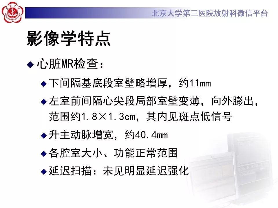 【PPT】心脏憩室