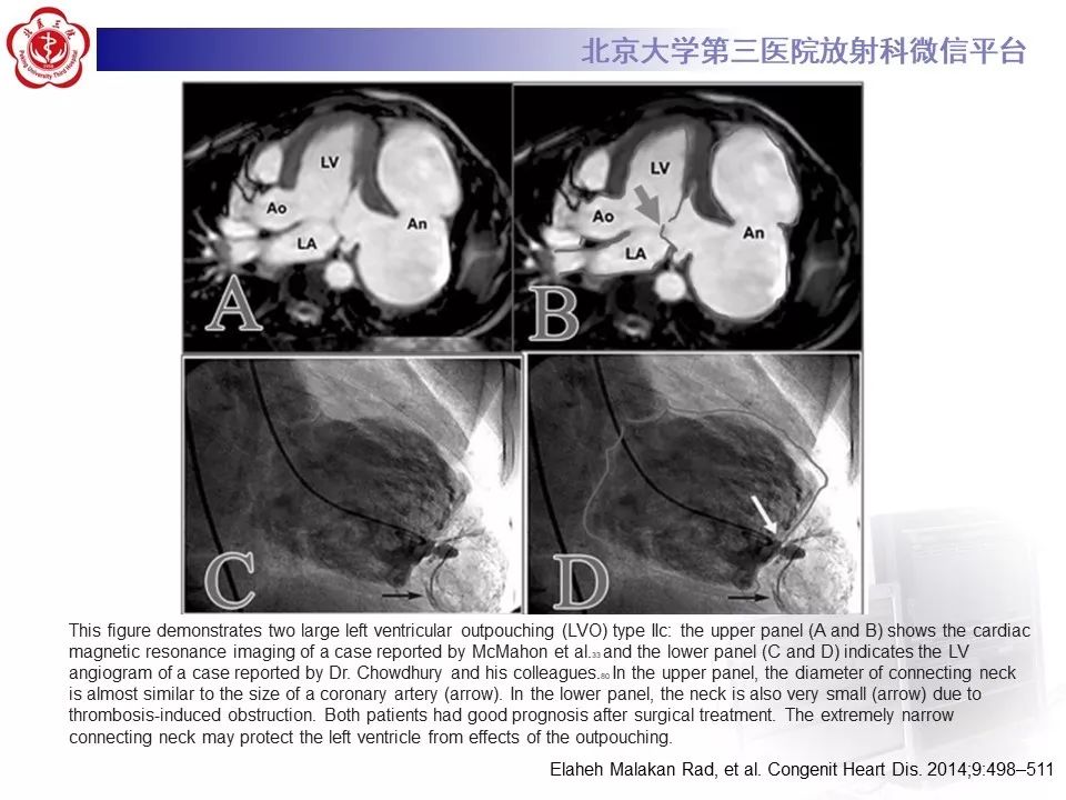 【PPT】心脏憩室
