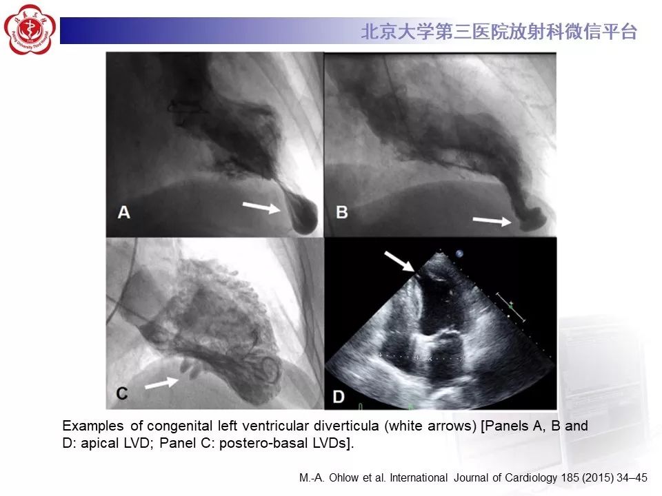 【PPT】心脏憩室