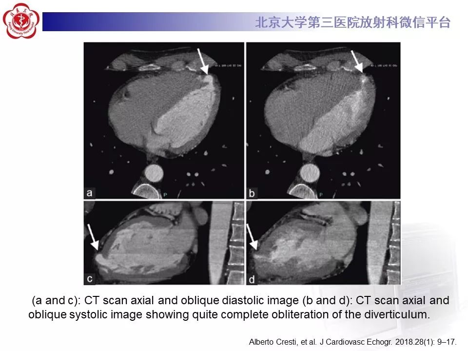 【PPT】心脏憩室
