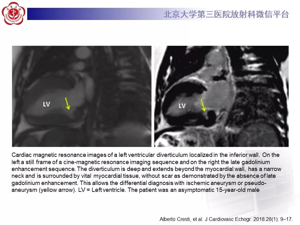 【PPT】心脏憩室