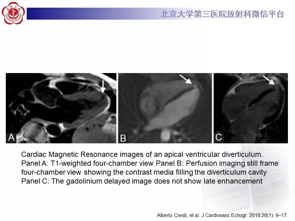 【PPT】心脏憩室
