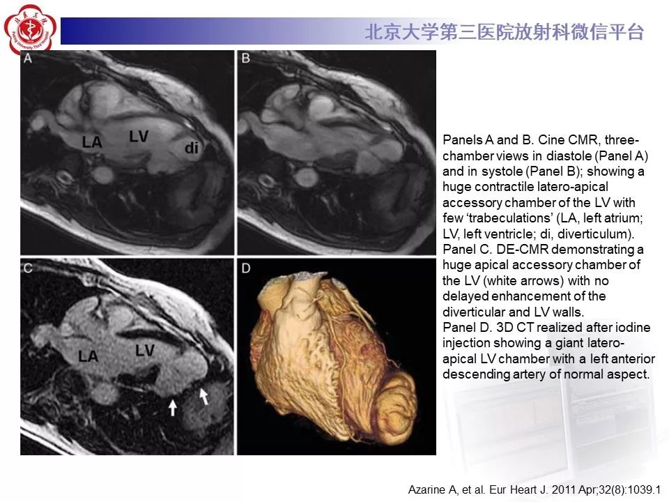 【PPT】心脏憩室