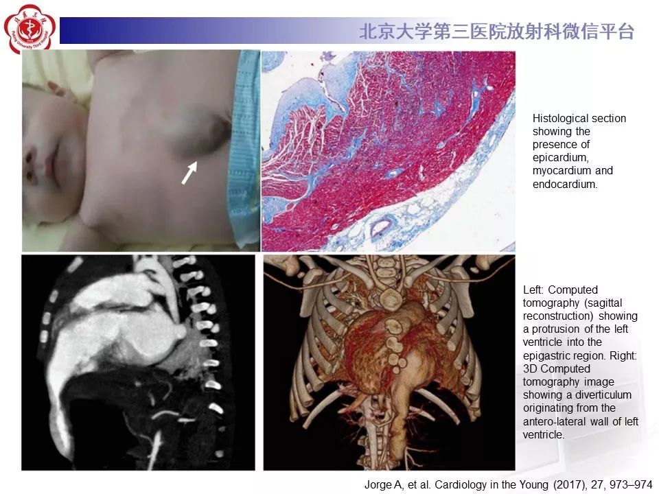 【PPT】心脏憩室