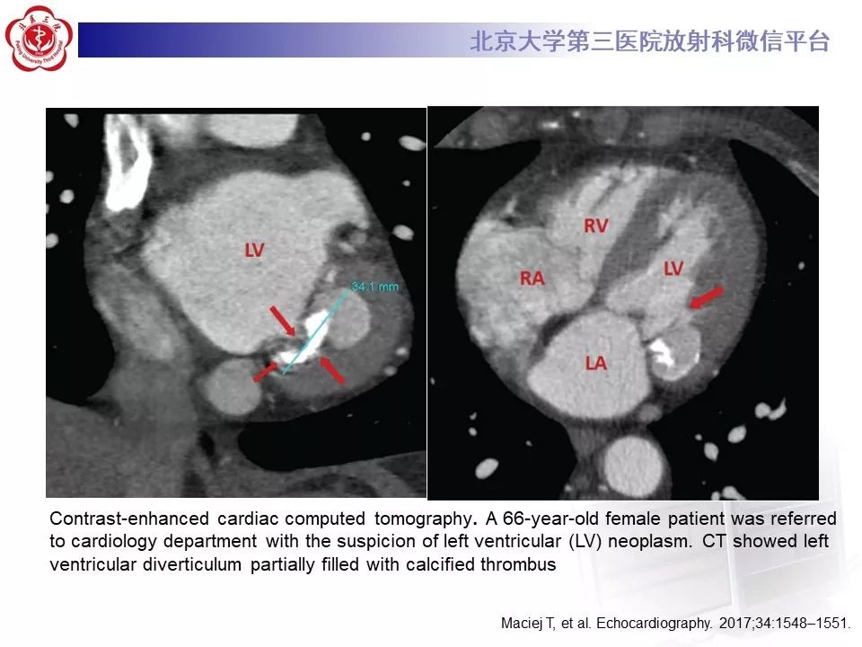【PPT】心脏憩室