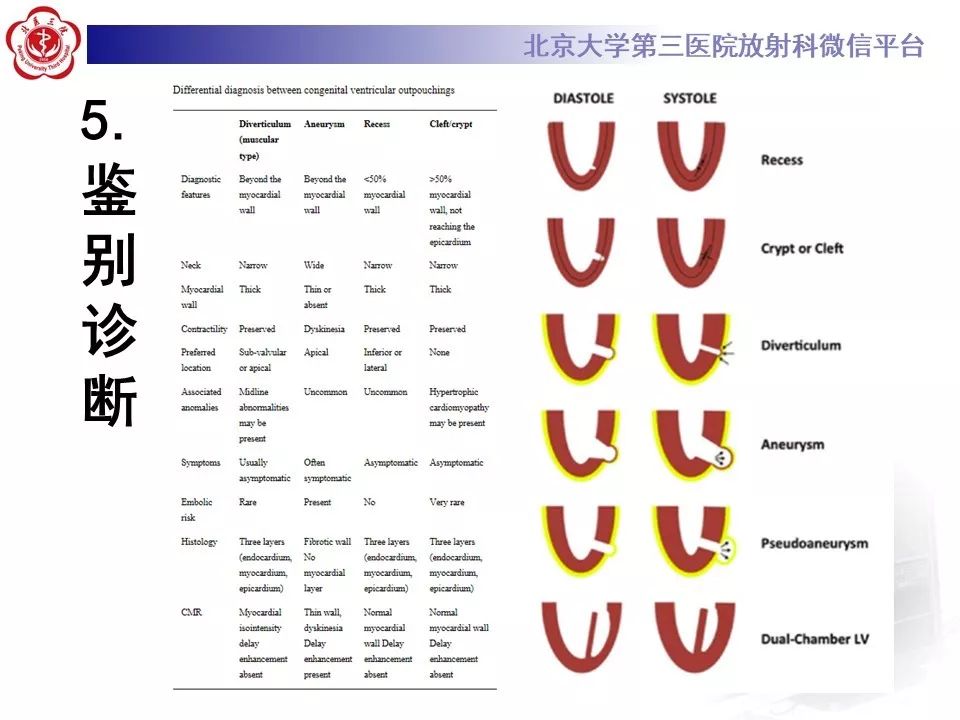 【PPT】心脏憩室