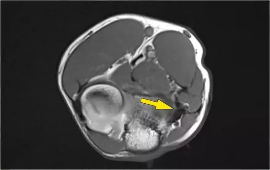 肘关节MR解剖及疾病详解 肘关节MR解剖及疾病详解