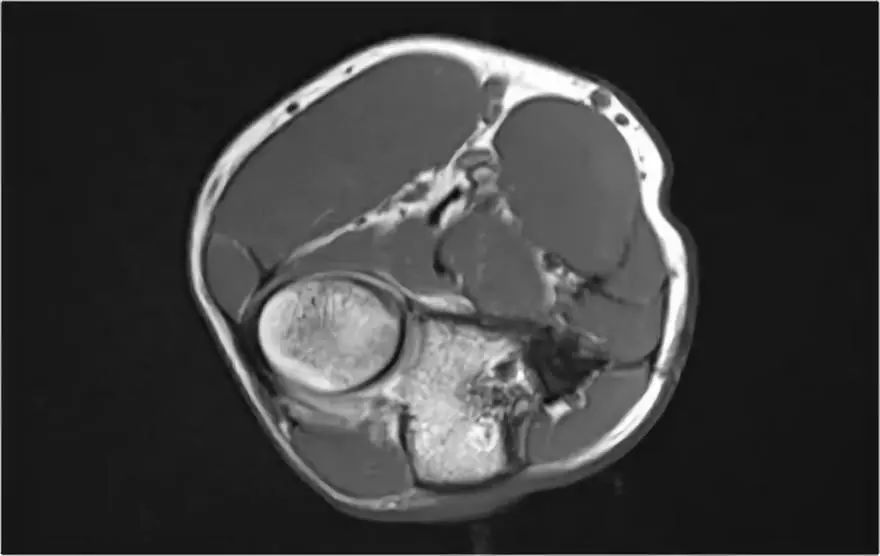 肘关节MR解剖及疾病详解 肘关节MR解剖及疾病详解